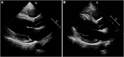 Case report: Dual atrioventricular nodal non-reentrant tachycardia with six types of ECG patterns leading to tachycardia-induced cardiomyopathy in a 51-year-old man